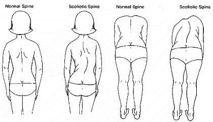 Adam's Forward Bend Test