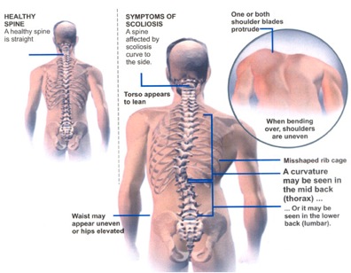 scoliosis1