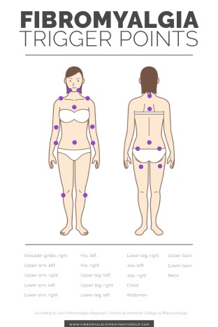 fibromyalgia-trigger-points